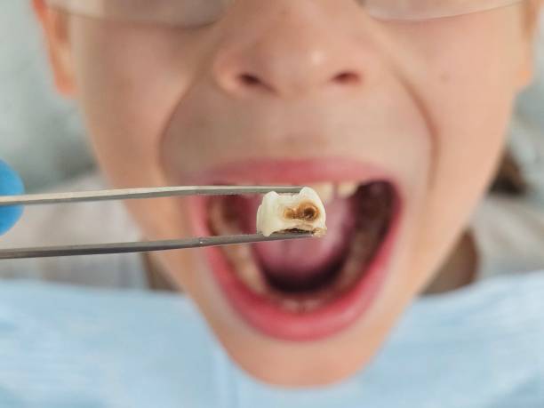 Best Emergency Dental Extractions in The Crossings, FL